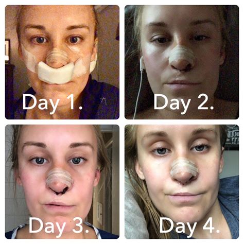 closed rhinoplasty recovery time